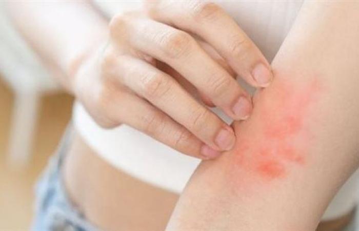 بالتزامن مع ارتفاع درجات الحرارة .. طرق الوقاية من ظهور التينيا بالجسم