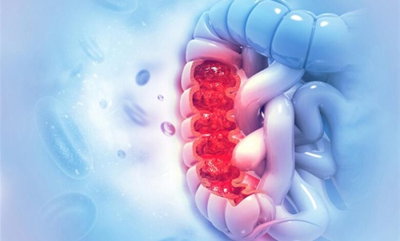 جرس إنذار.. أعراض غير متوقعة قد تشير إلى سرطان القولون عند الشباب